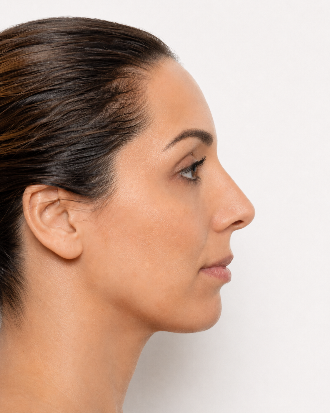 After rhinoplasty nasal refinement result